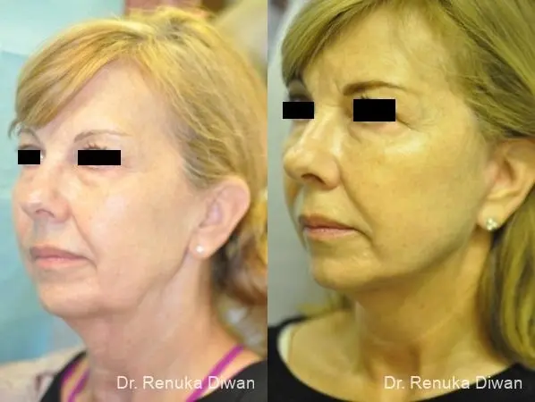 Facelift: Patient 10 - Before and After 1
