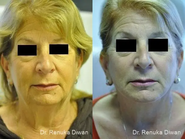 Facelift: Patient 2 - Before and After  