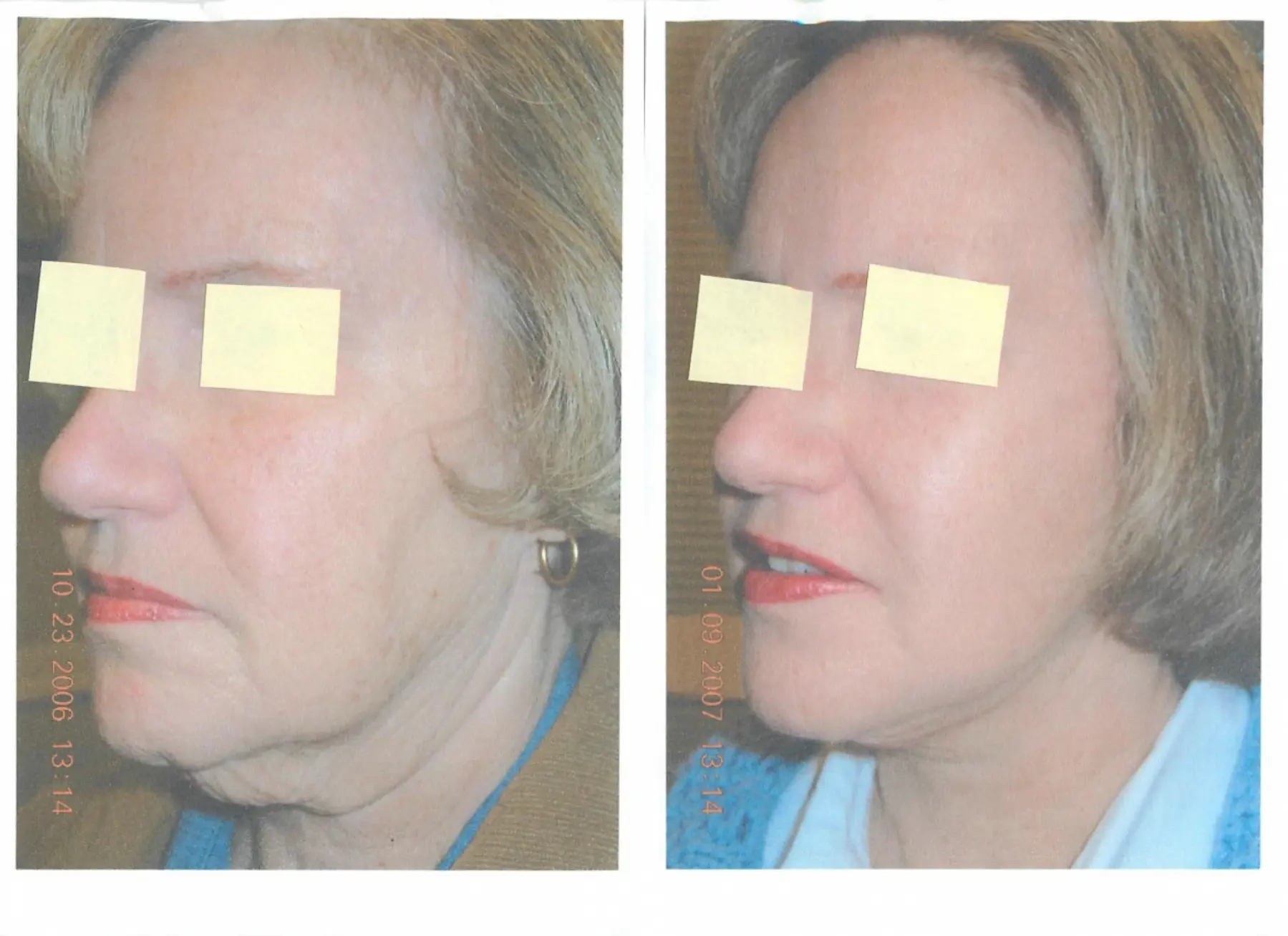 Facelift: Patient 9 - Before and After 1