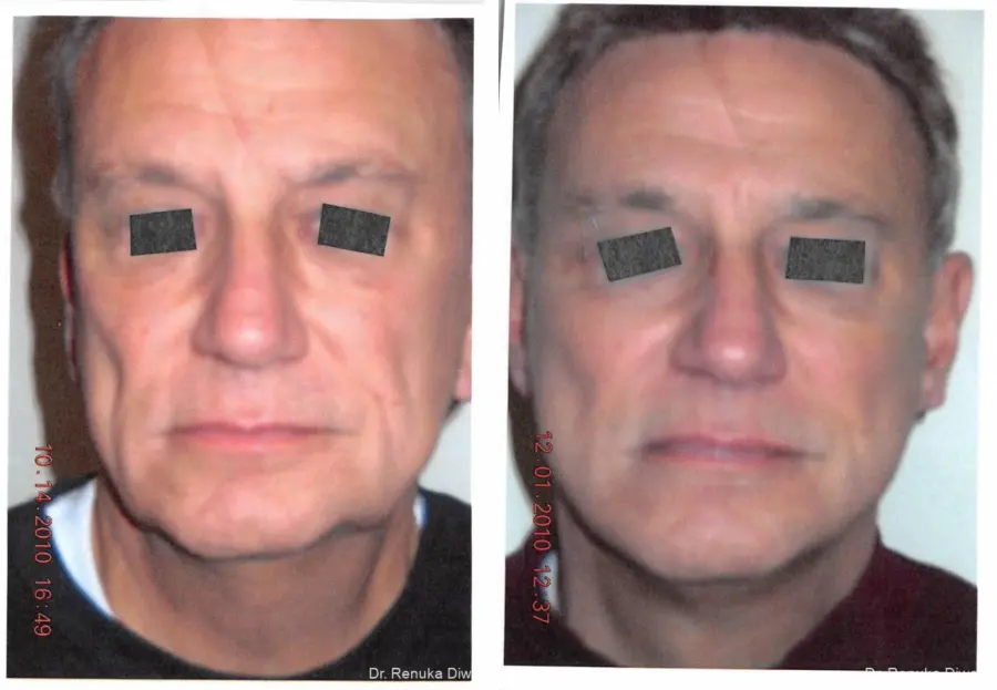 Facelift For Men: Patient 1 - Before and After 2