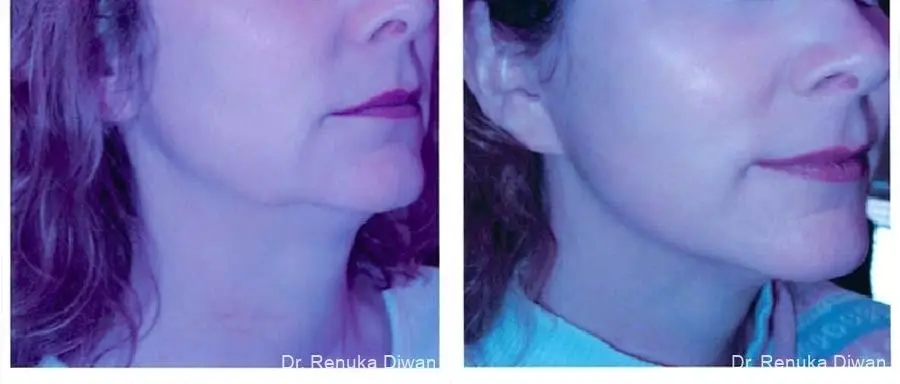 Facelift: Patient 6 - Before and After  