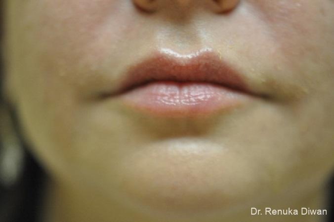 Lips And Mouth: Patient 12 - After 1