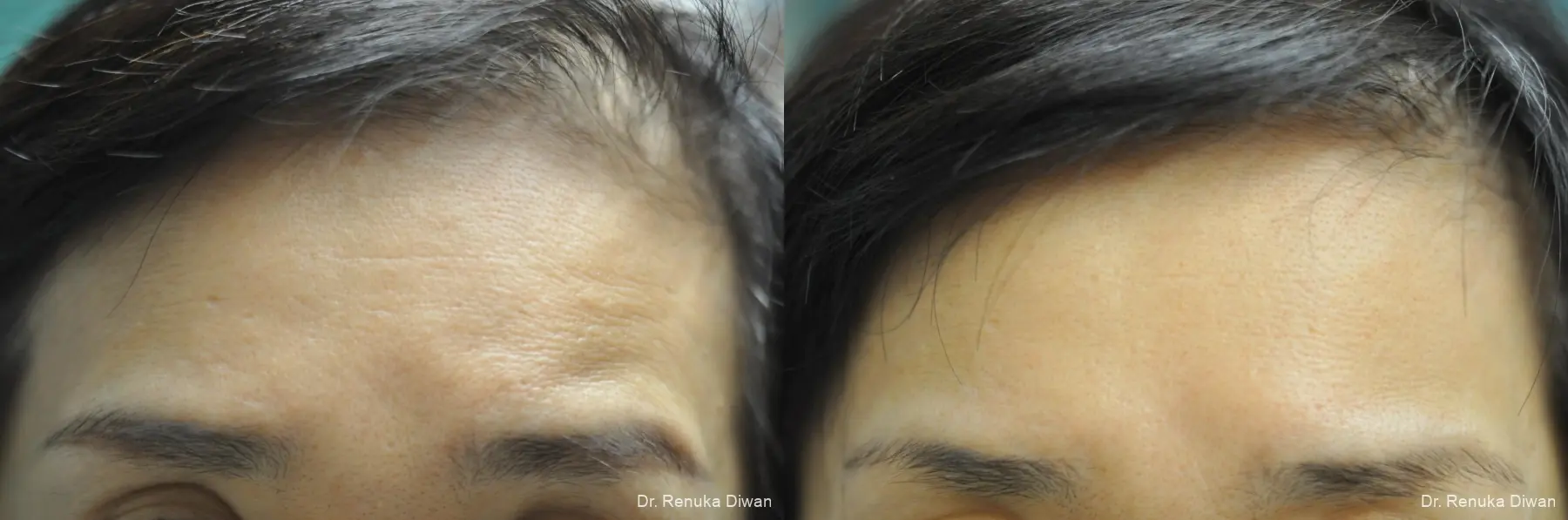 Forehead Creases: Patient 10 - Before and After 1