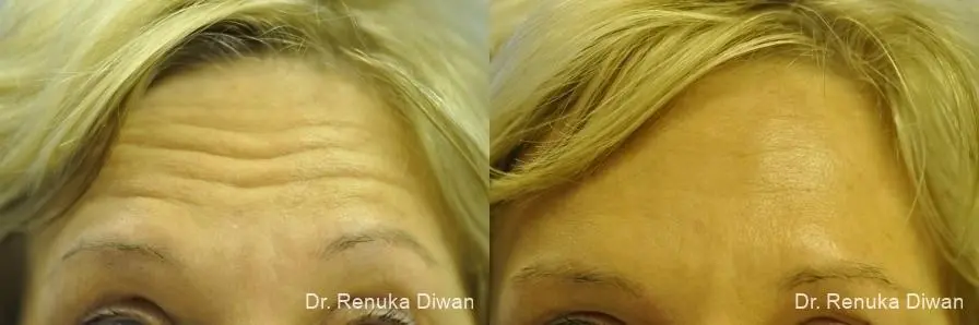Forehead Creases: Patient 14 - Before and After 2