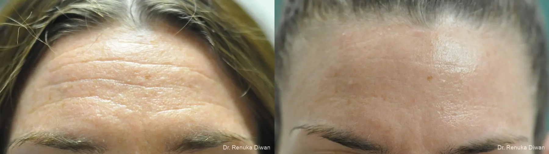 Forehead Creases: Patient 15 - Before and After 1