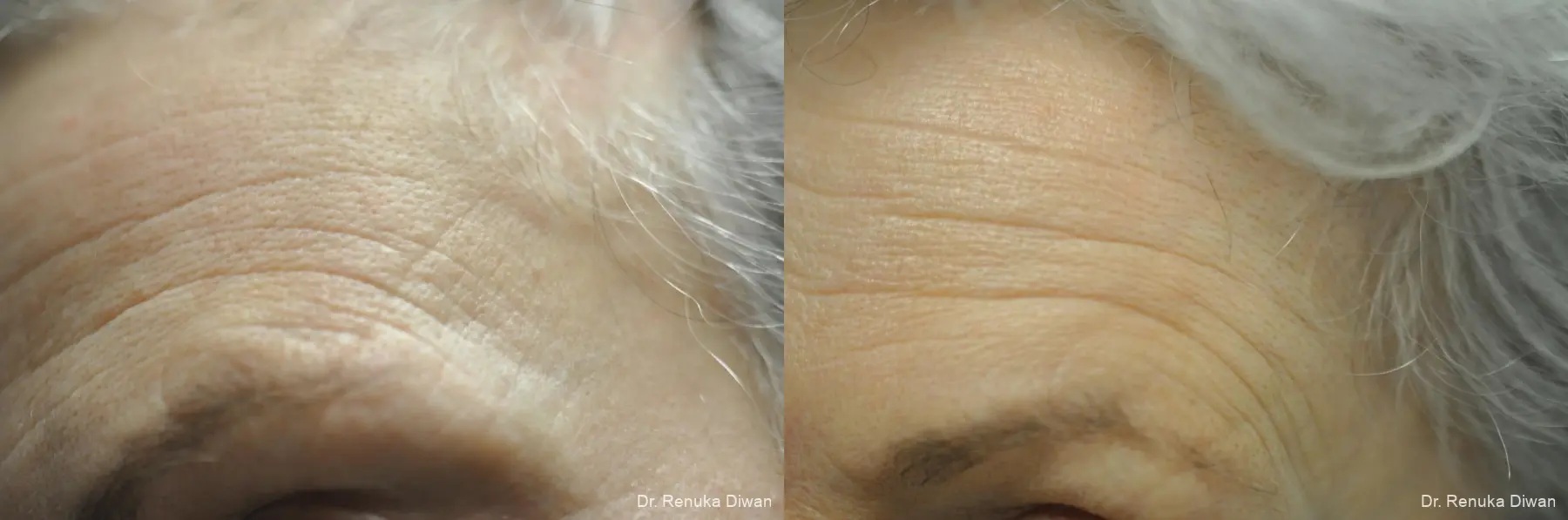 Forehead Creases: Patient 16 - Before and After 1