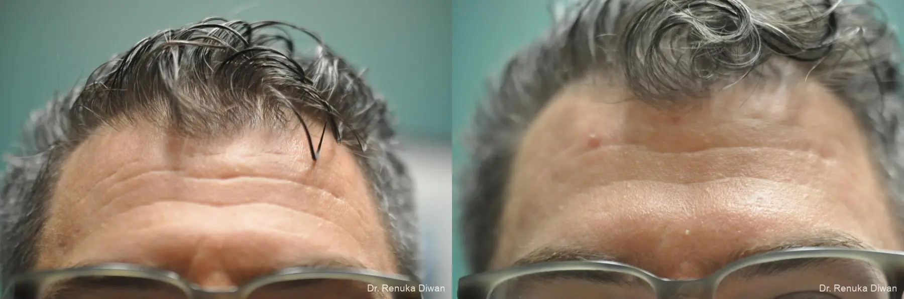 Forehead Creases: Patient 11 - Before and After 1