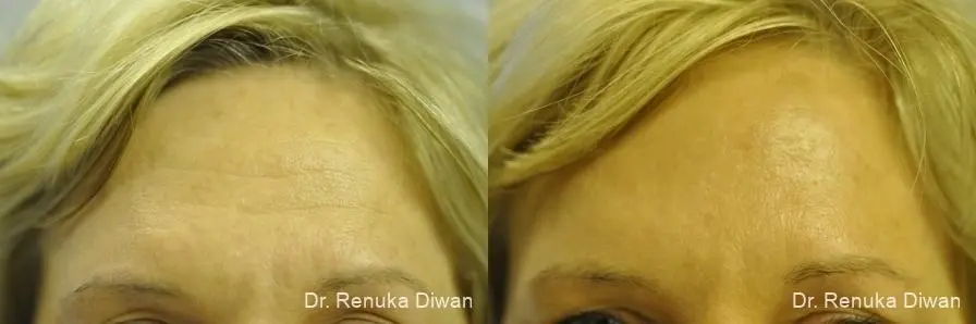 Forehead Creases: Patient 14 - Before and After 1