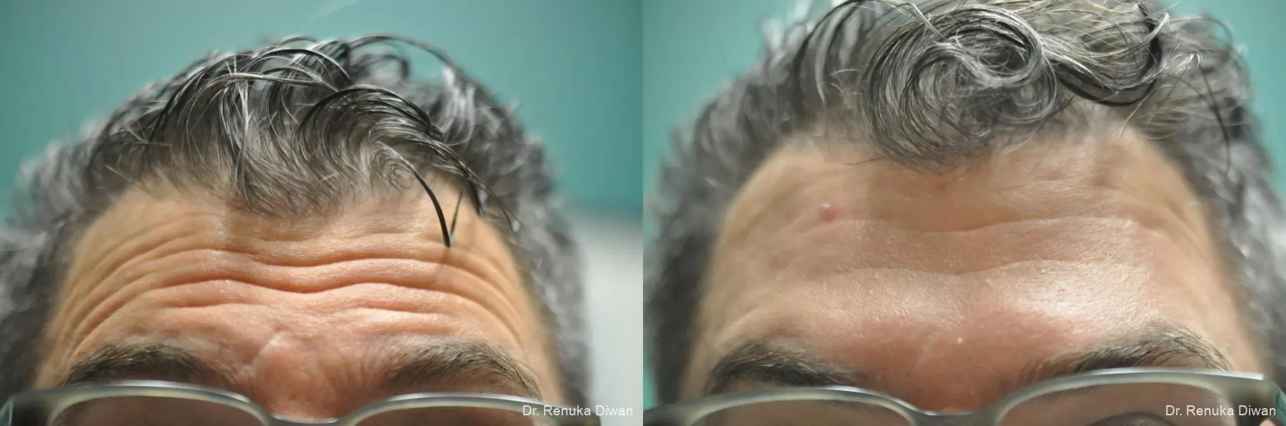 Forehead Creases: Patient 11 - Before and After 2