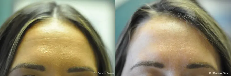 Forehead Creases: Patient 9 - Before and After  