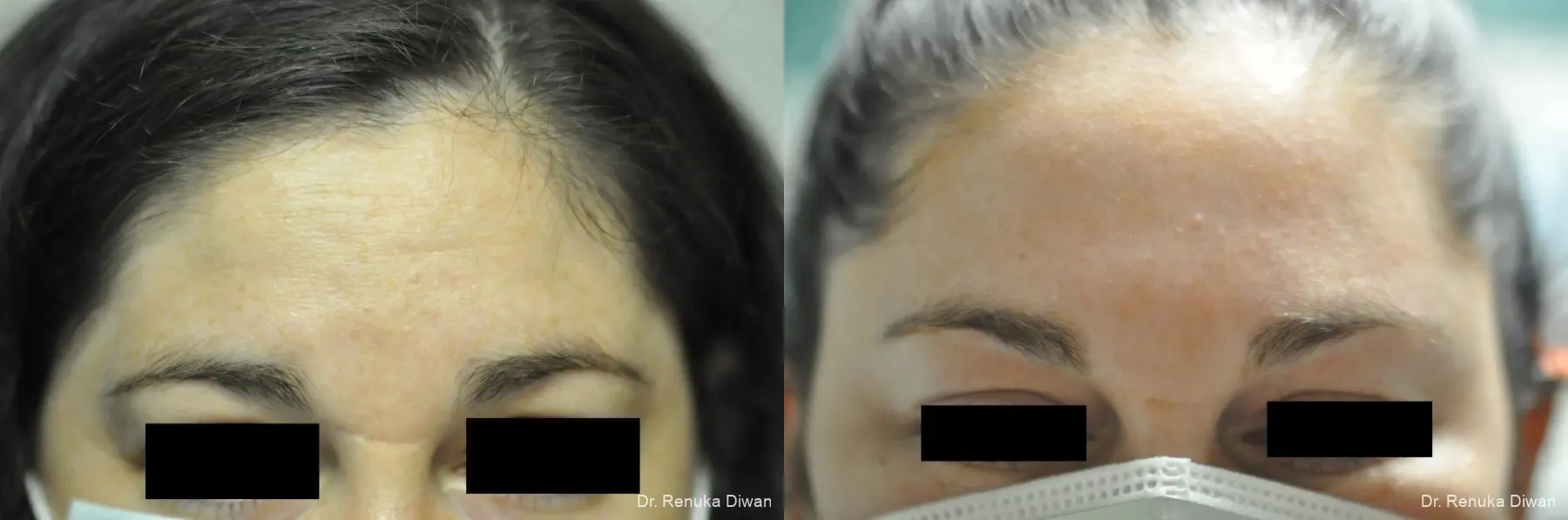 Forehead Creases: Patient 12 - Before and After 1