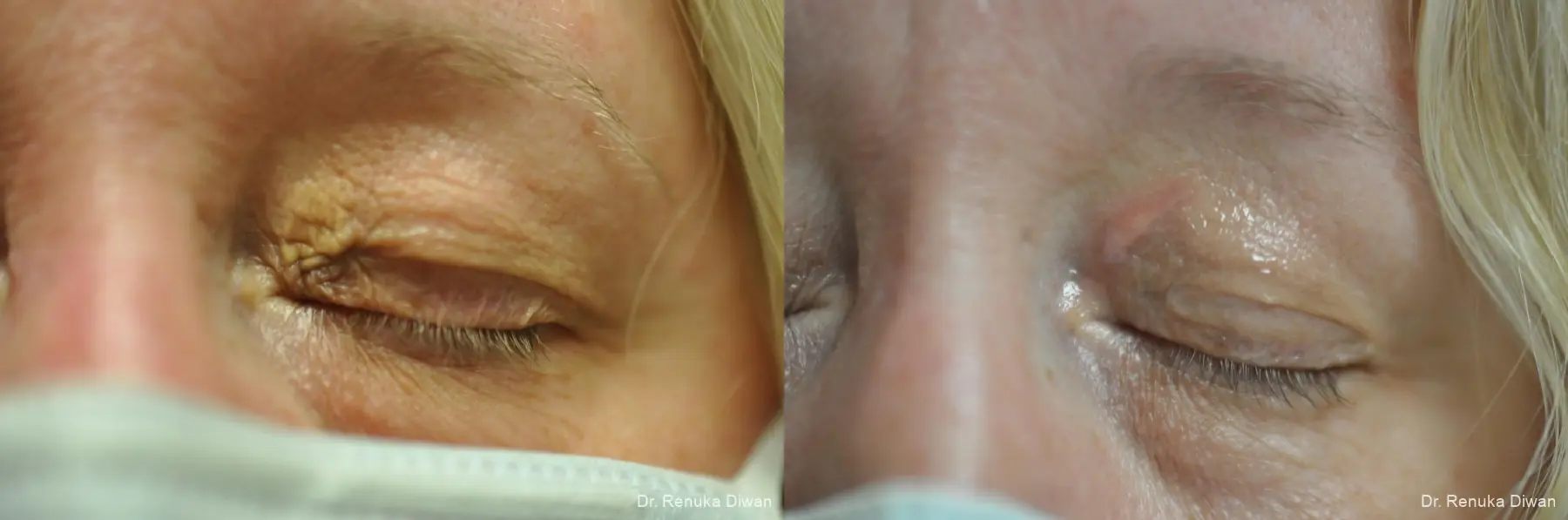 Fractional Resurfacing: Patient 1 - Before and After 1