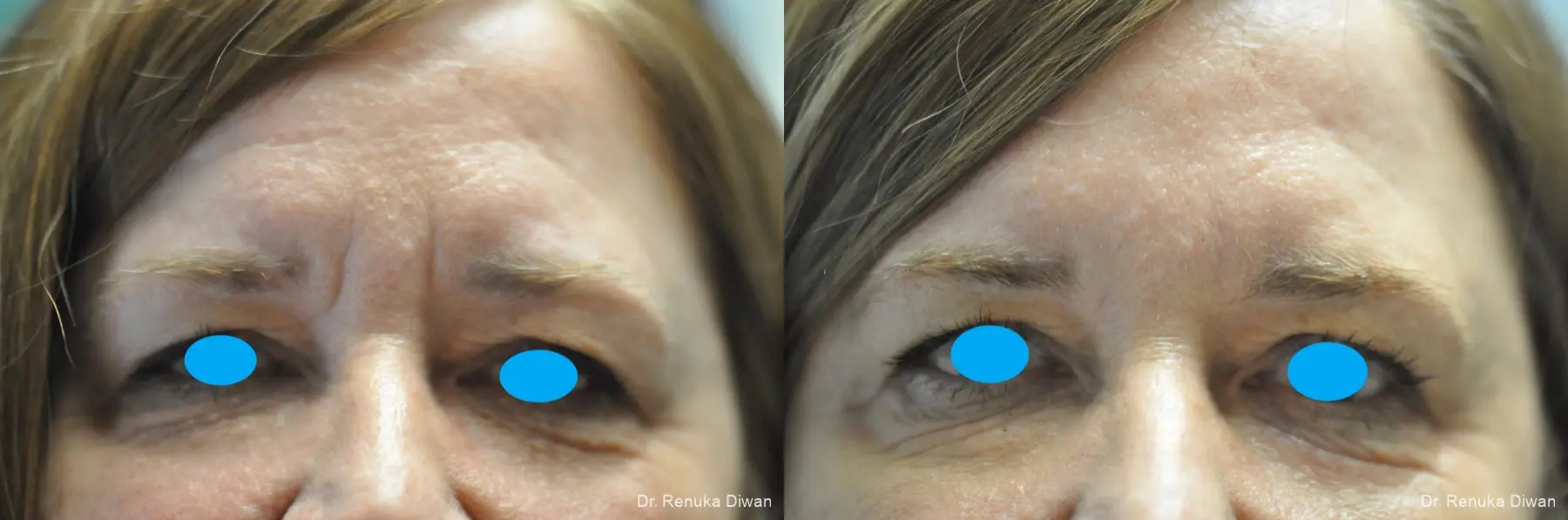 Frown Lines: Patient 14 - Before and After 1