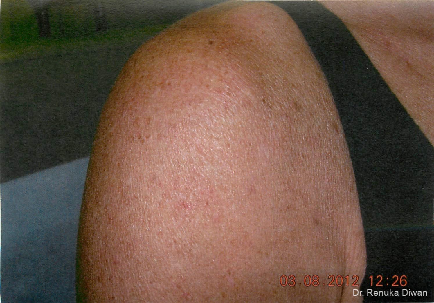 Lasers For Brown Spots: Patient 5 - After  