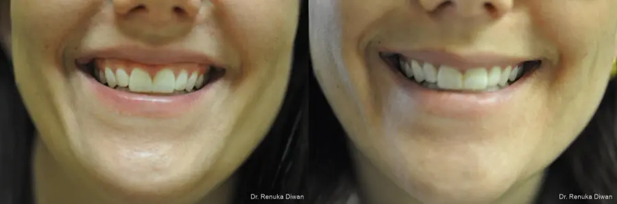 Gummy Smile: Patient 4 - Before and After  
