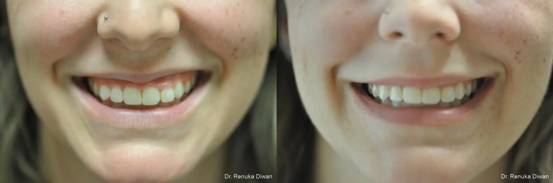 Gummy Smile: Patient 6 - Before and After 1
