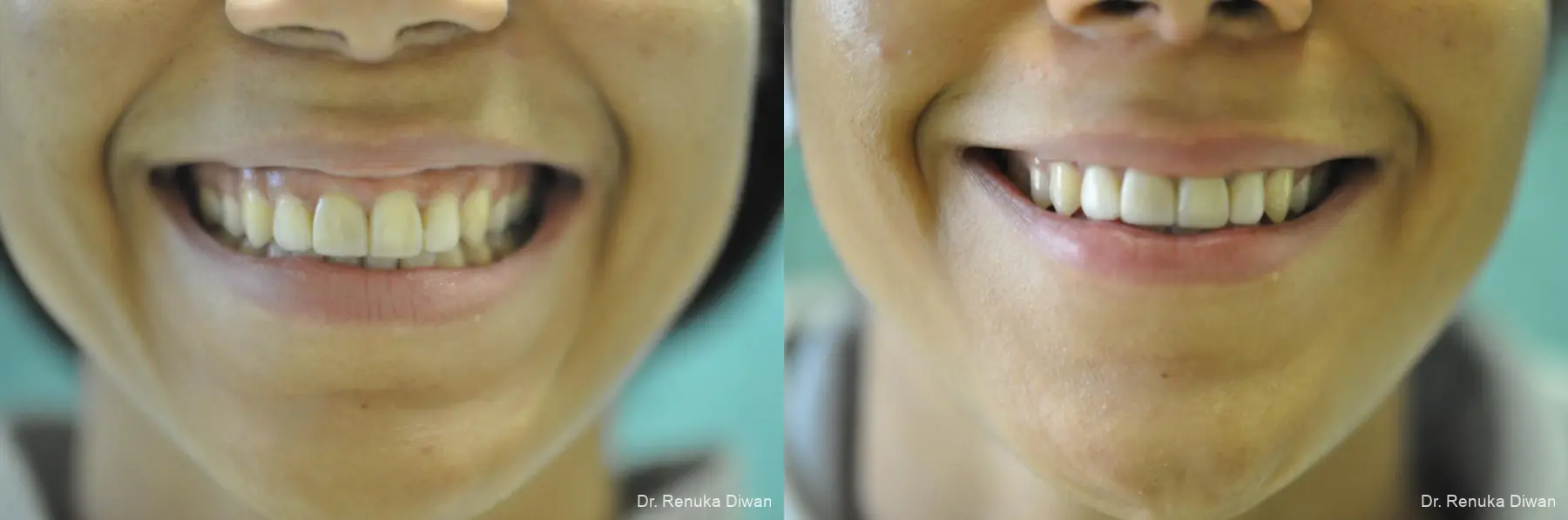 Gummy Smile: Patient 3 - Before and After 1