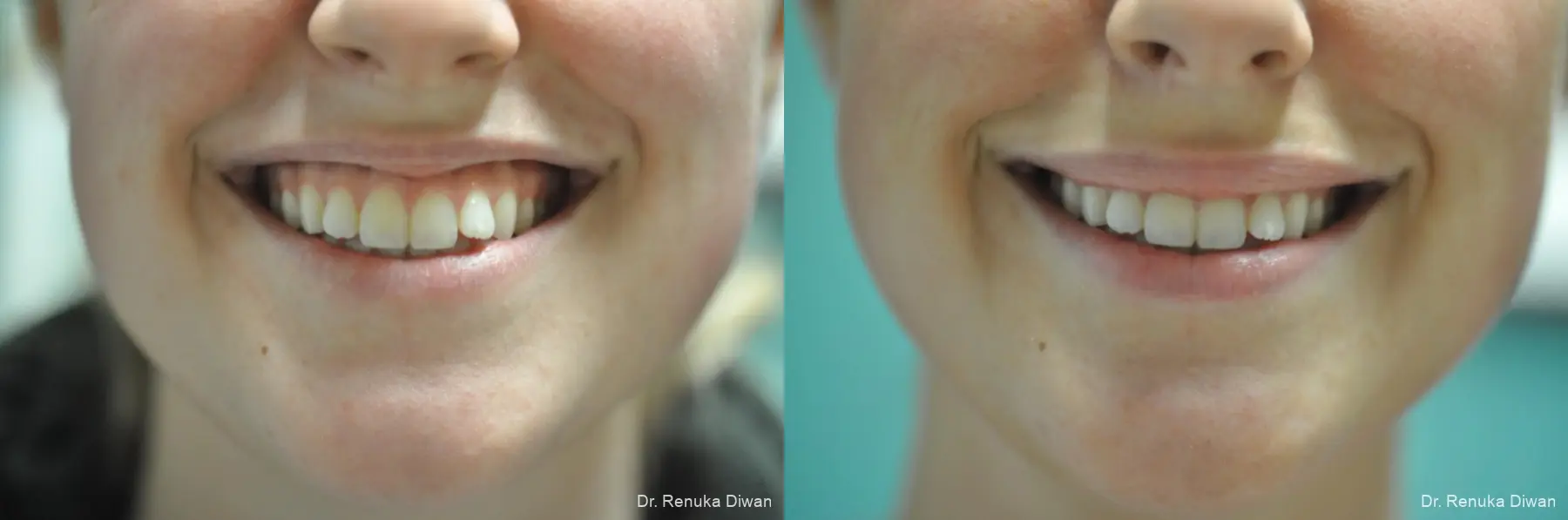 Gummy Smile: Patient 5 - Before and After 1