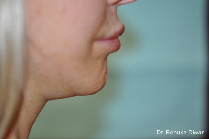 Chin Augmentation: Patient 4 - Before 