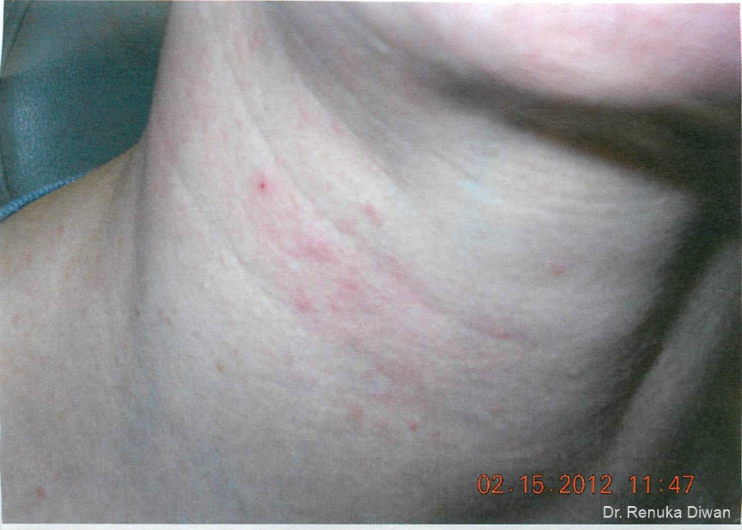 Neck Creases: Patient 4 - Before 