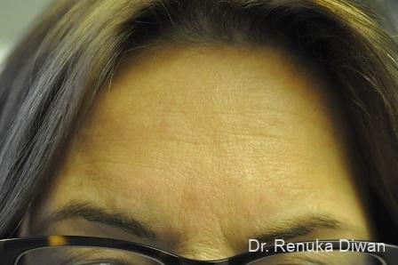Forehead Creases: Patient 8 - Before 