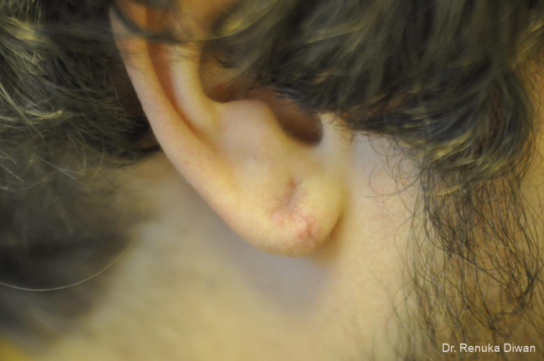 Earlobe Surgery: Patient 2 - After  