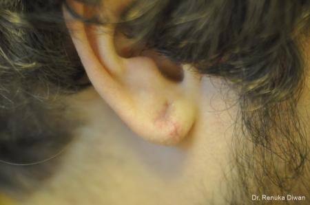 Earlobe Surgery: Patient 1 - After  