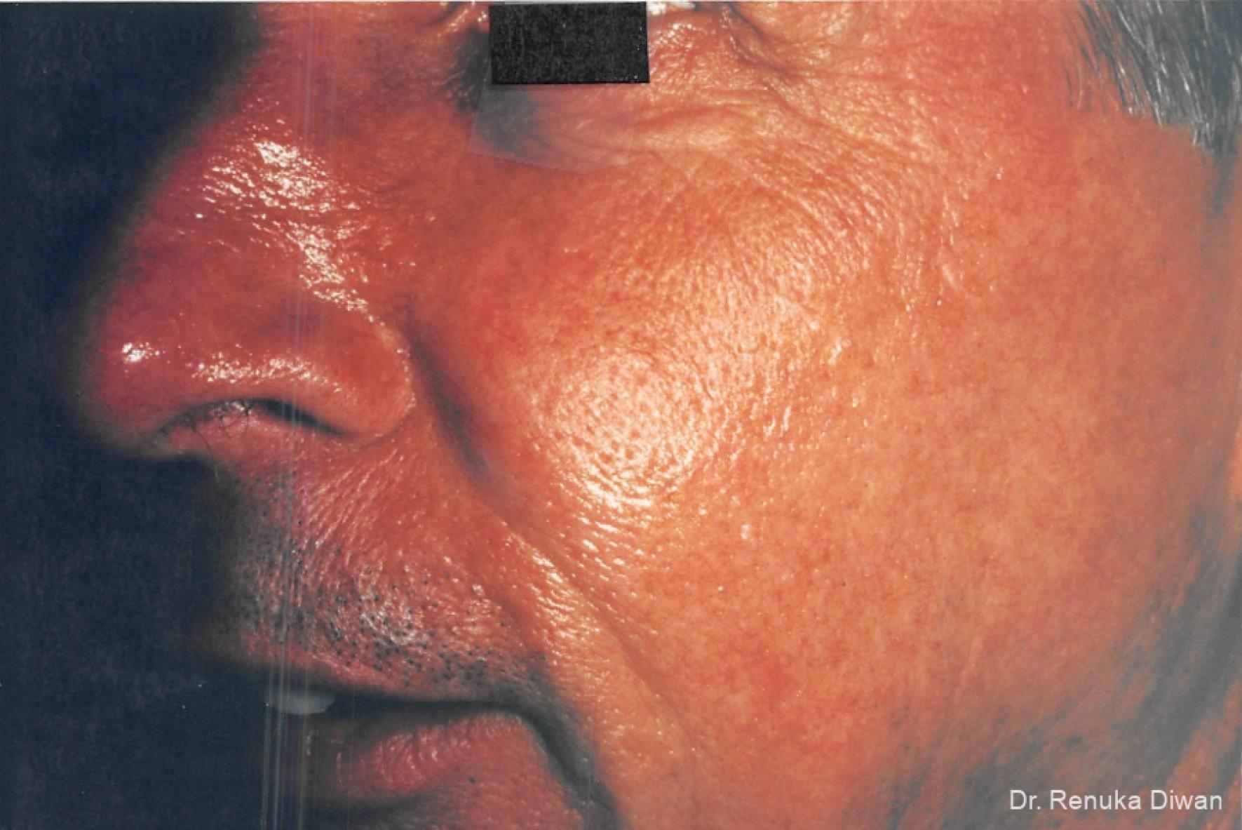 Laser-for-veins-and-redness-for-men: Patient 5 - After  