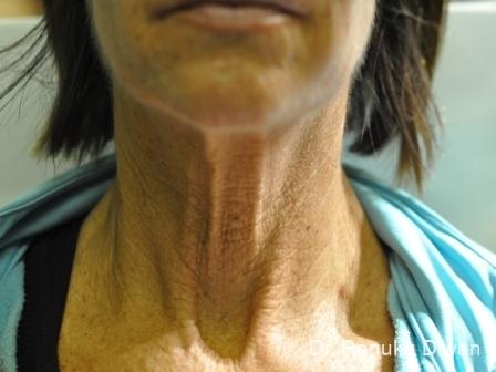 Skin Tightening: Patient 5 - Before 