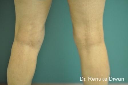 CoolSculpting®: Patient 2 - After  