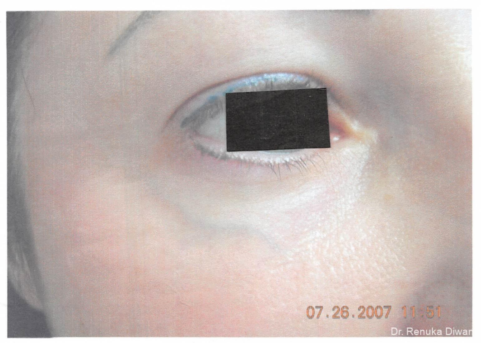 Laser For Veins And Redness: Patient 9 - Before 1