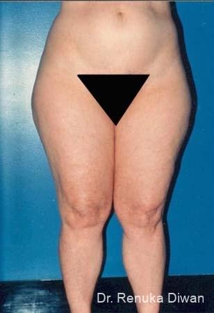 Liposuction: Patient 8 - Before 