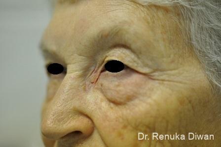 Blepharoplasty: Patient 10 - Before 