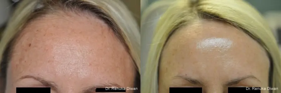 IPL: Patient 4 - Before and After  