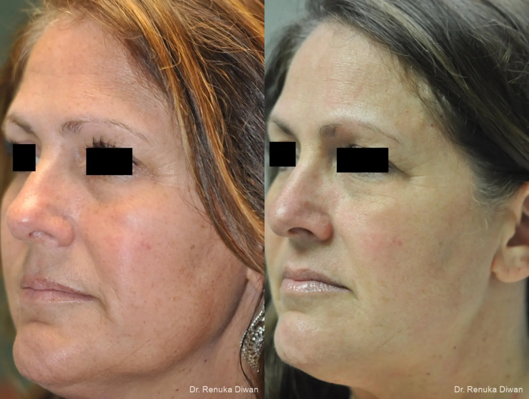 IPL: Patient 9 - Before and After 2