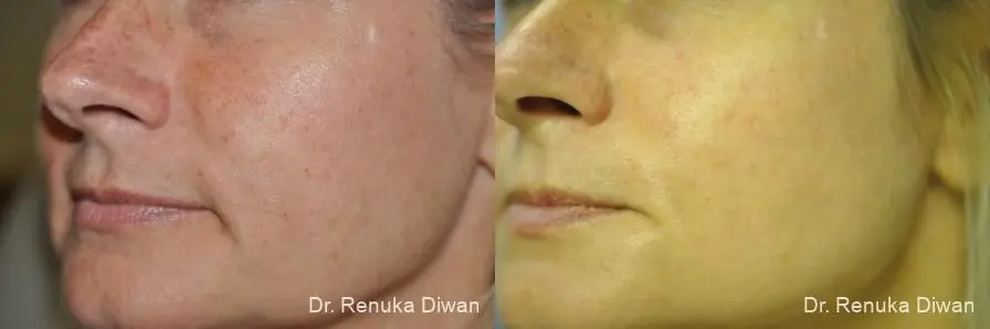 IPL: Patient 4 - Before and After 2
