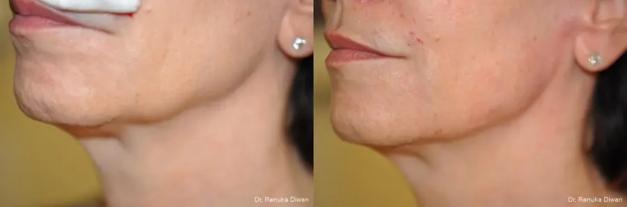 Jawline Augmentation: Patient 4 - Before and After  