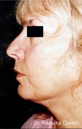 Liposuction: Patient 3 - After 1