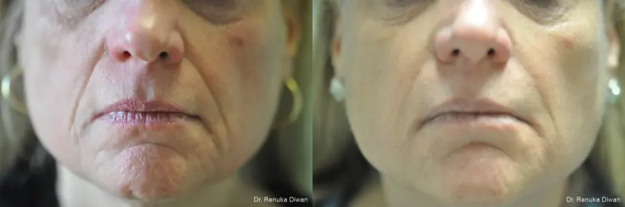Juvéderm® XC: Patient 8 - Before and After 1