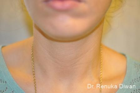 Kybella: Patient 2 - After 1