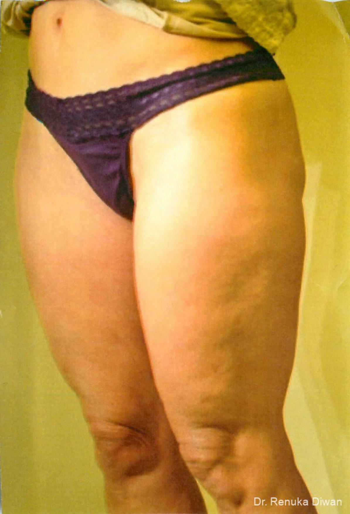 Cellulite Reduction: Patient 2 - Before and After 2