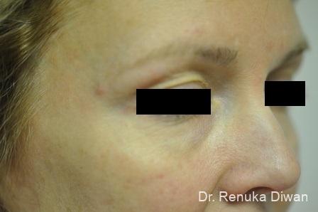 BOTOX® Cosmetic: Patient 24 - After Image