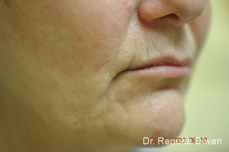 Lips And Mouth: Patient 17 - Before 1