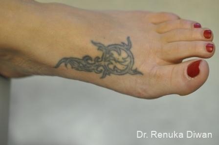 Tattoo Removal: Patient 6 - Before 