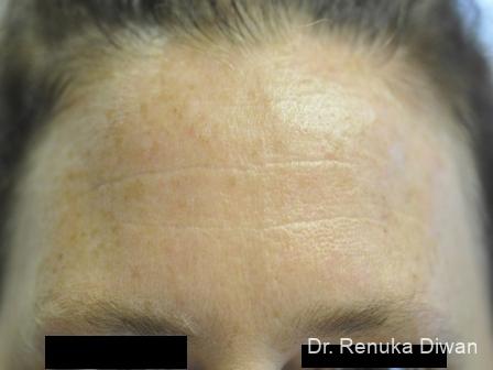 BOTOX® Cosmetic: Patient 11 - Before Image