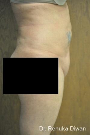 Liposuction: Patient 14 - After 1