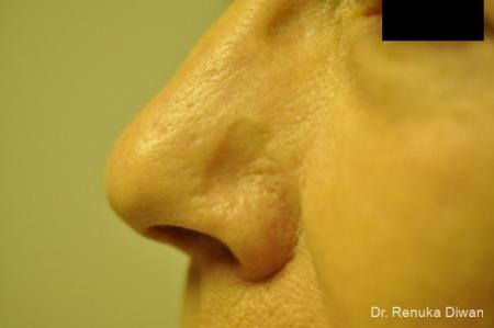 Laser: Patient 1 - Before Image