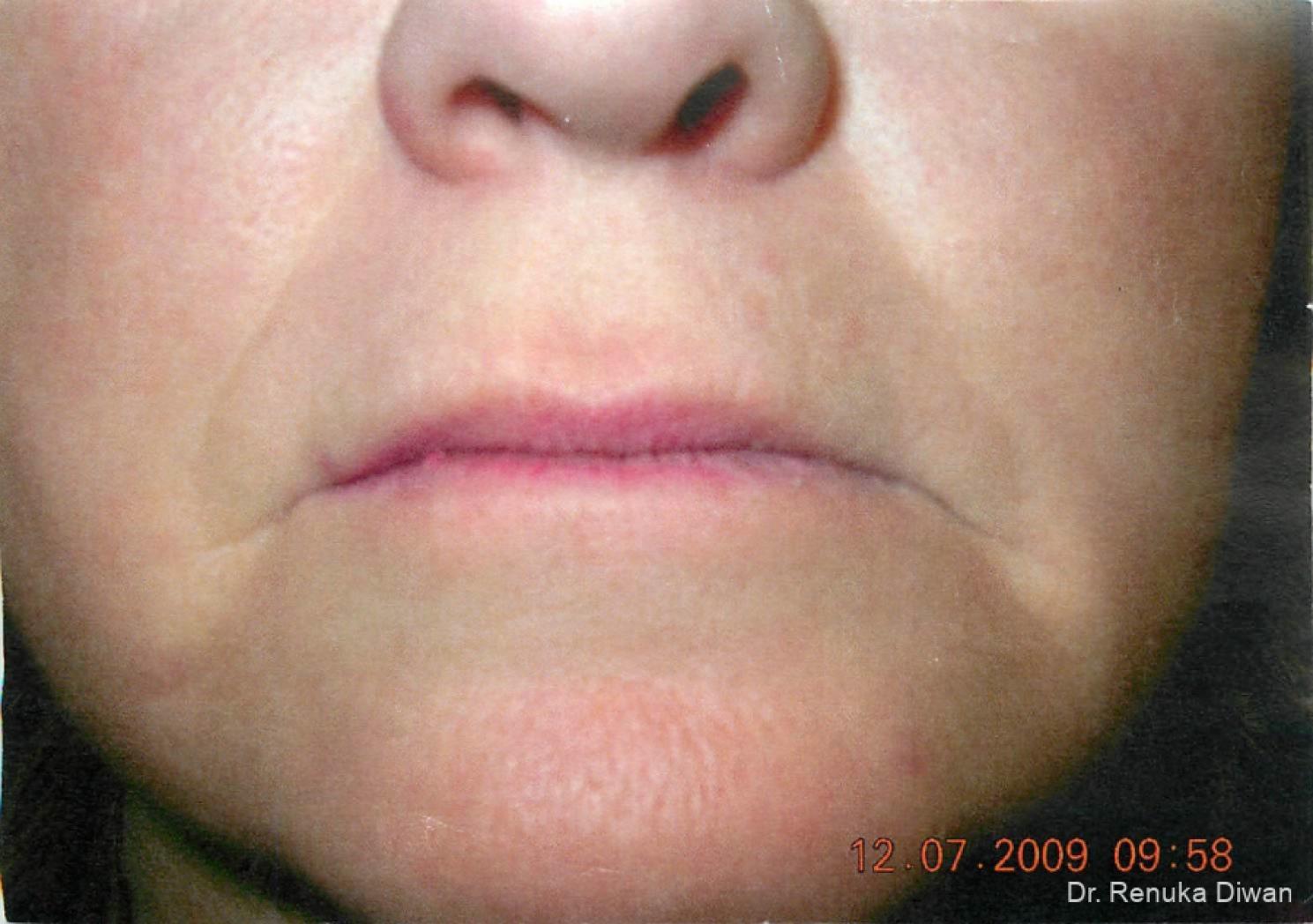 Marionette Lines: Patient 4 - Before 