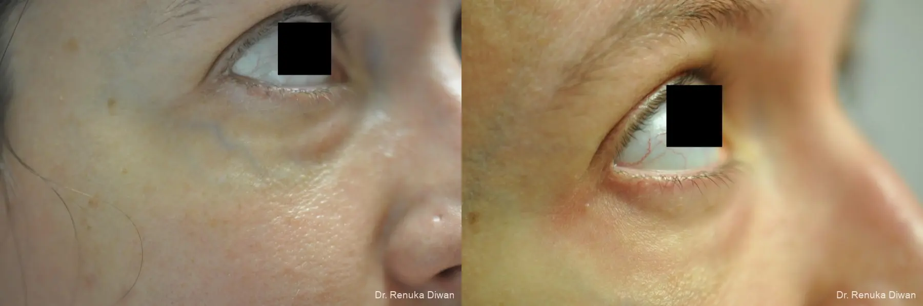 Laser For Veins And Redness: Patient 13 - Before and After 1