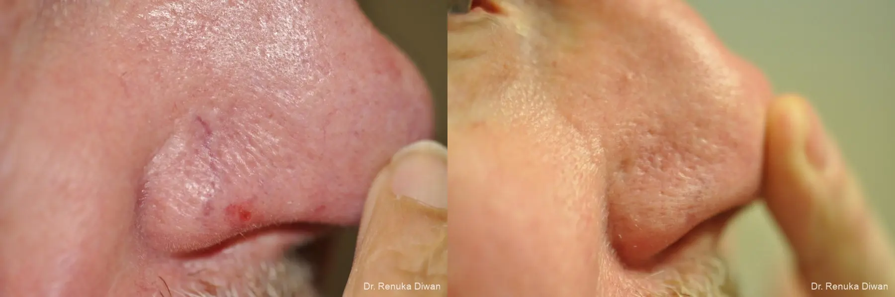Laser For Veins And Redness For Men: Patient 11 - Before and After 1
